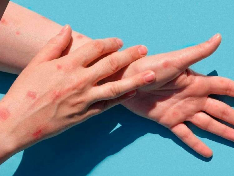 Confirman un caso de viruela del mono en San Isidro: no tenía antecedentes de viaje